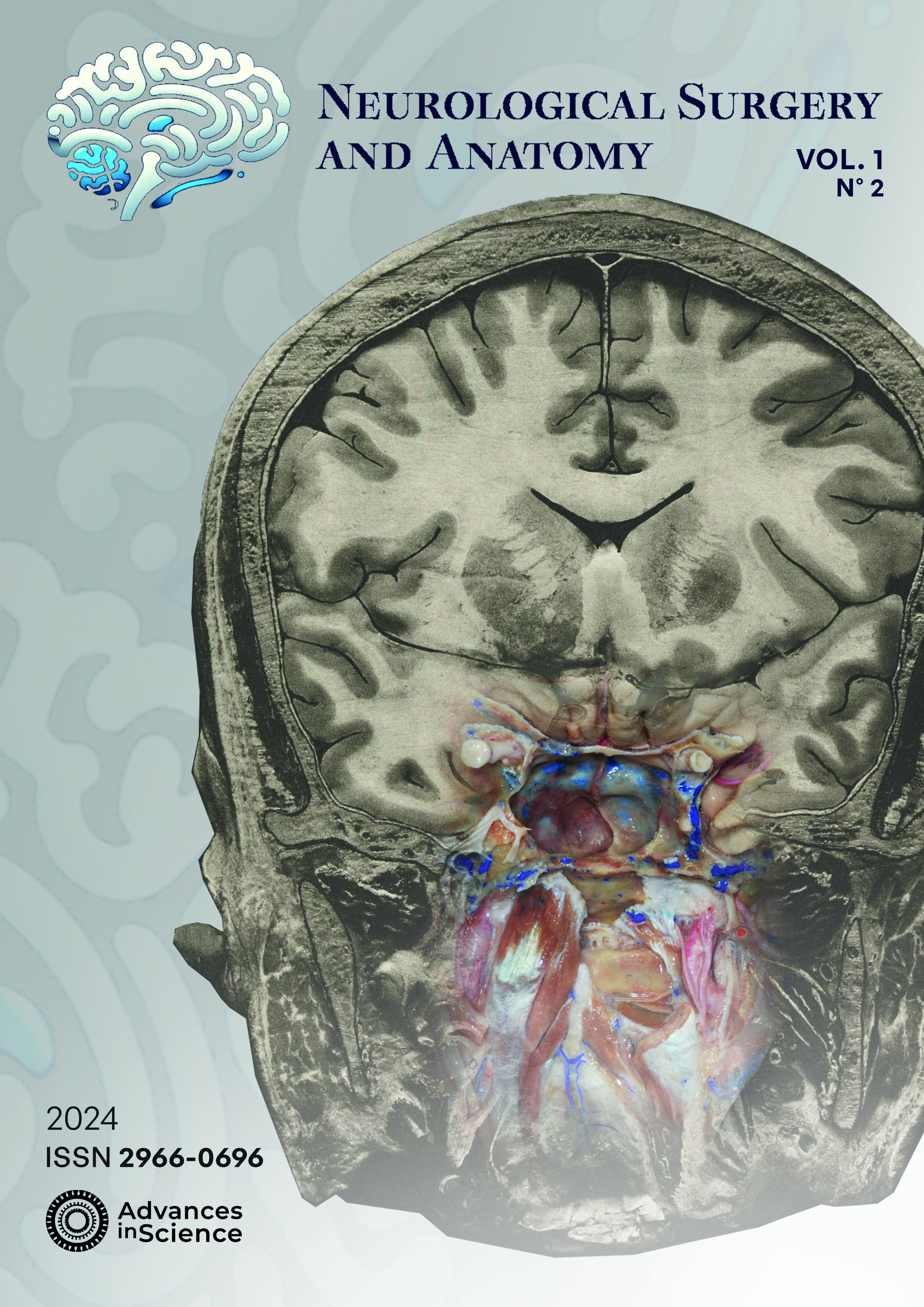 Coronal cut from Macewen´s Atlas of Coronal Sections, embedded with a dissection of a silicone injected cadaveric head which progressed, using microneurosurgical techniques. Martins, A. C. de A., Martins, C., & Valença M.M. (2024). The advent of modern brain surgery: 100 years since William Macewen. Neurological Surgery and Anatomy, 1(2).